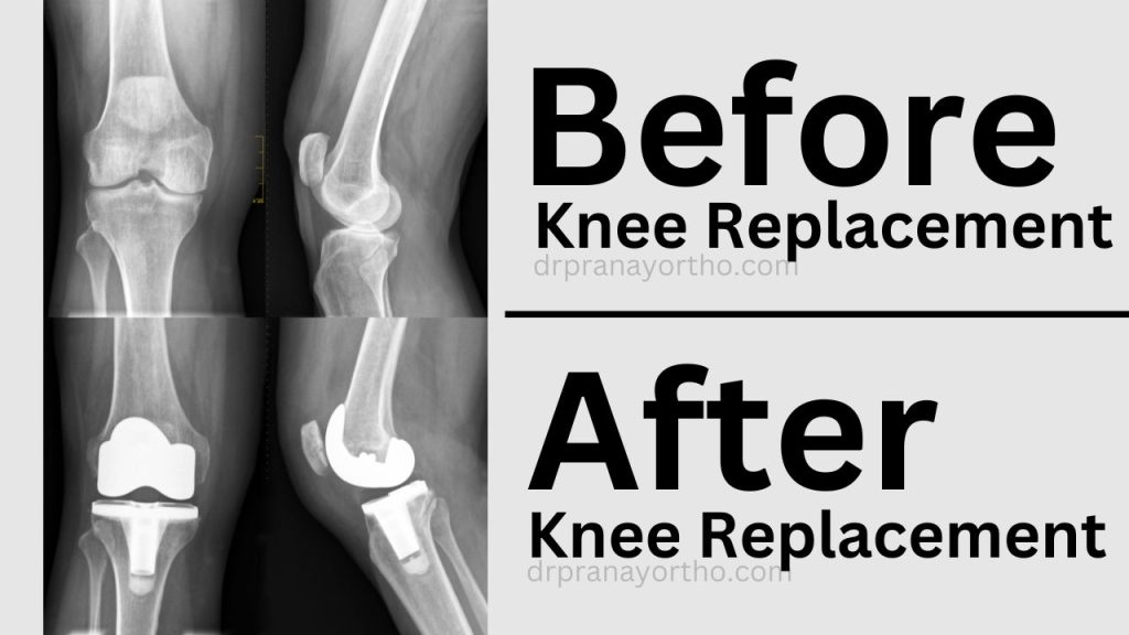 Knee Replacement Surgery 3 before and after knee replacement surgery